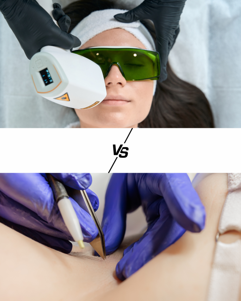 Laser ou électrolyse