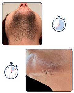 comparaison pilosité visage